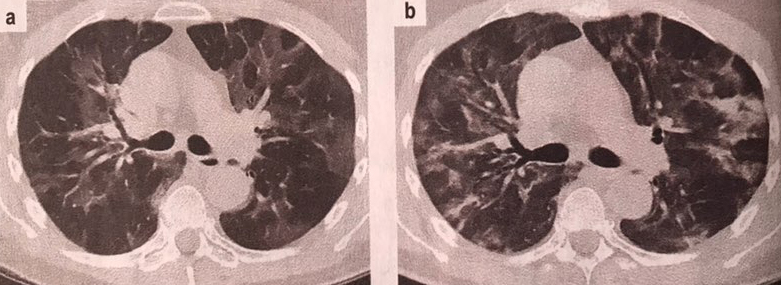 Коронавирусээр өвдсөн 58 настай өвчтөний уушгиний томографик зураг. А. Өвчний эхэн шат B. 10 хоногийн дараах өөрчлөлт